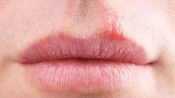 Dấu hiệu nhận biết bệnh chàm môi