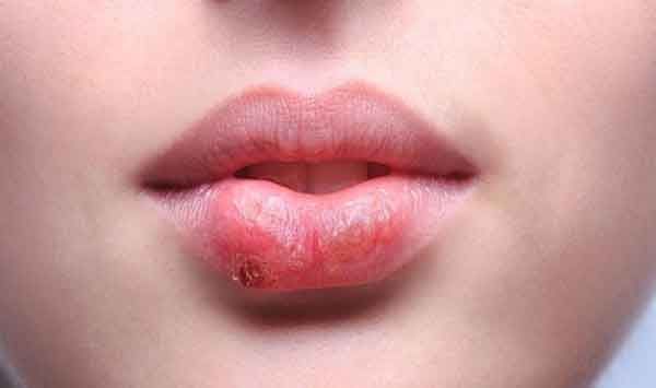 Bệnh chàm môi là gì?