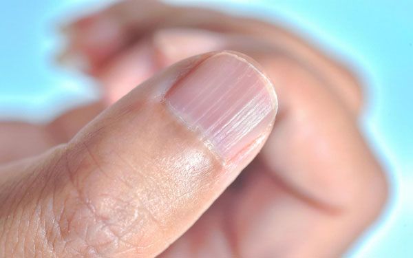 16 dấu hiệu móng tay có sọc bất thường chớ chủ quan