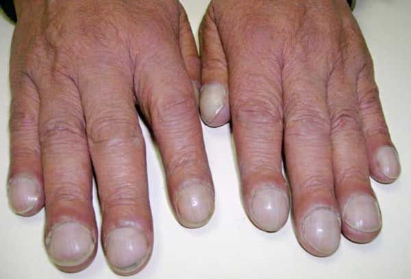 16 dấu hiệu móng tay có sọc bất thường chớ chủ quan