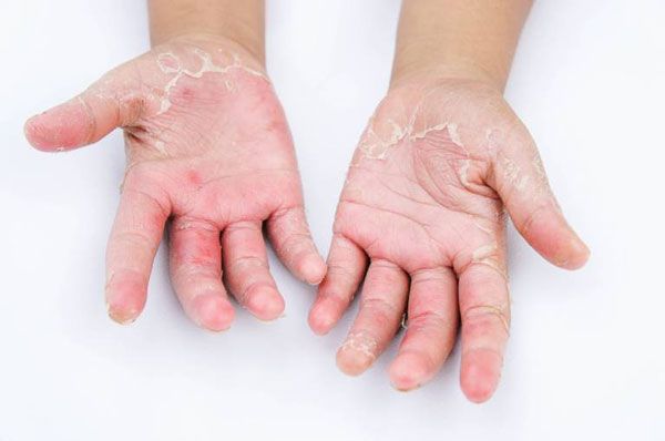 Da tay bị bong tróc là bệnh gì? Nguyên nhân và cách phục hồi da?