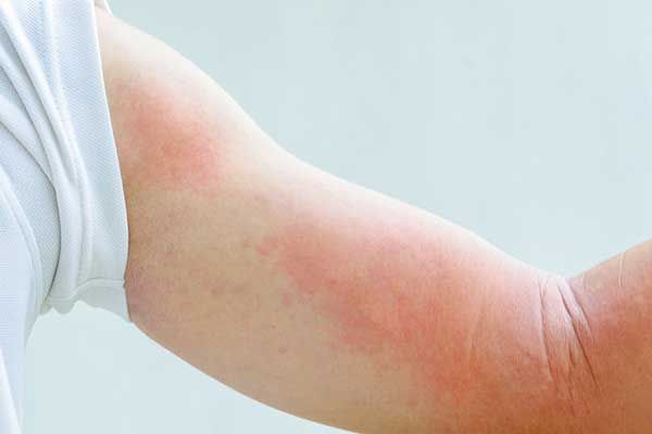 Tùy mực độ sẽ có thời gian phục hồi khác nhau