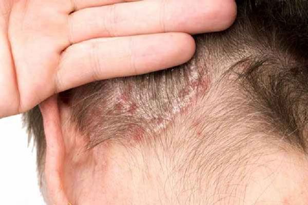 Dấu hiệu bị dị ứng thuốc nhuộm tóc
