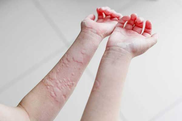 Nổi mề đay, ngứa rát