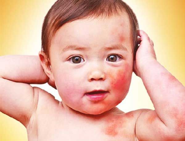 Dị ứng thịt bò xảy ra ở mọi lứa tuổi