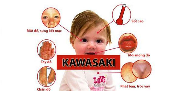 Triệu chứng bệnh Kawasaki