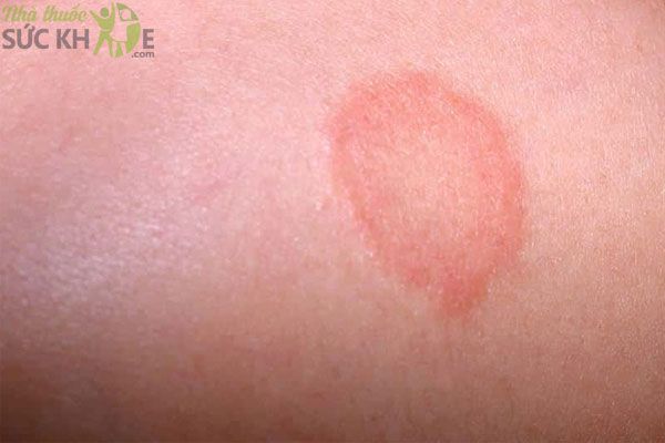 Bệnh lác đồng tiền hay còn tên gọi khác là bệnh hắc lào