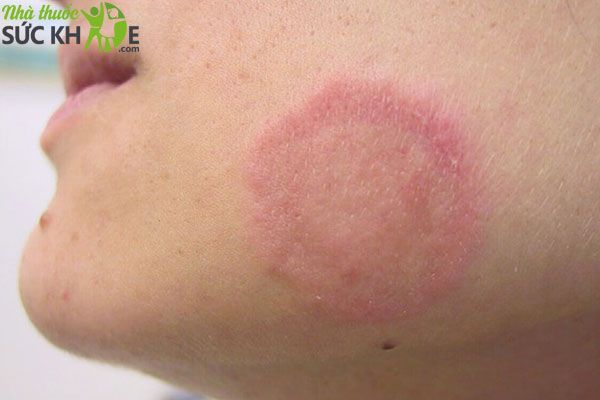 Nấm đồng xu (lác đồng tiền) có để lại thâm sẹo