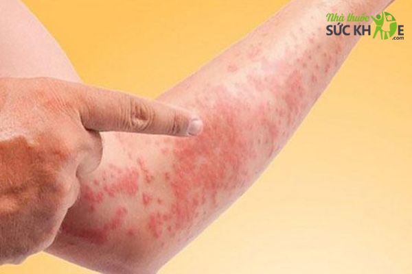 Thuốc Loratadin nhanh chóng làm giảm các triệu chứng dị ứng 