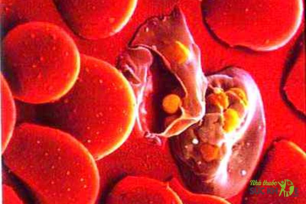 Malaria là gì? Lây truyền như thế nào? Triệu chứng và cách phòng ngừa?