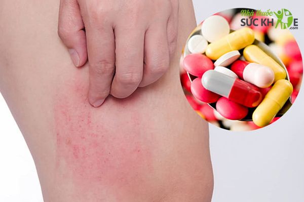Thuốc Loratadin dạng viên nén là phổ biến nhất 