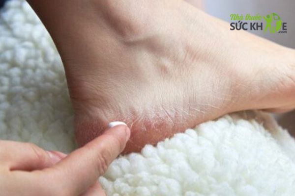 Sử dụng Vaseline trị nứt gót chân