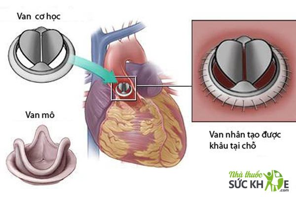 Điều trị bệnh hở van tim giai đoạn nặng 