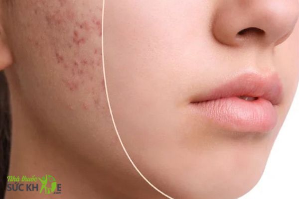 Ngăn ngừa và hỗ trợ điều trị mụn