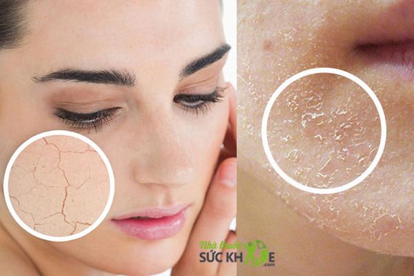 Mặt nạ cấp nước cho da khô