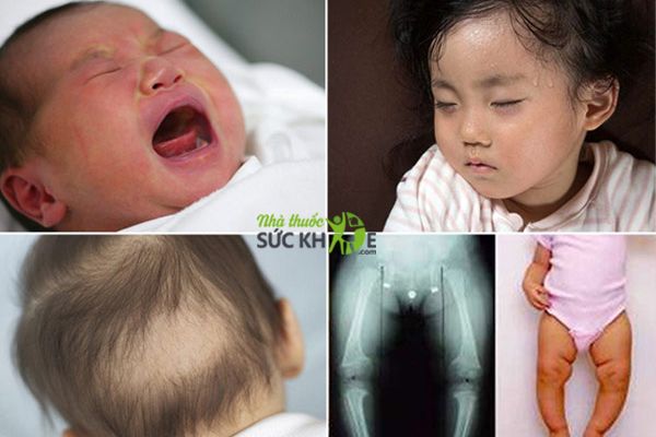 Thiếu Vitamin D