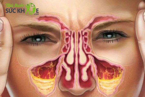 Phân loại thuốc xịt viêm mũi dị ứng trên thị trường 