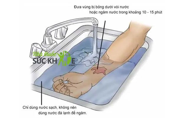 Cách chữa bỏng bằng nước mát