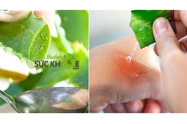 Mẹo chữa bỏng tại nhà bằng nha đam