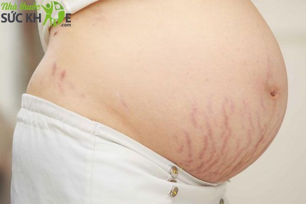 Hơn 90% phụ nữ gặp tình trạng rạn da khi mang thai 