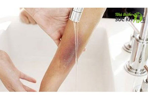 Làm dịu vết bỏng với nước mát 
