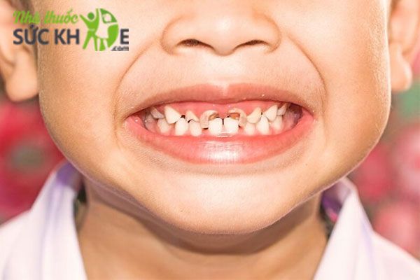Trẻ em có cần dùng nước súc miệng không