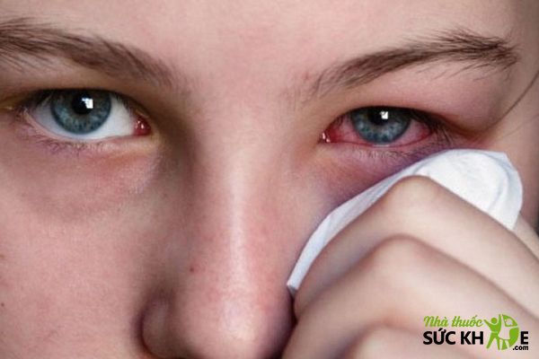 Khô, đỏ mắt là tác dụng phụ có thể gặp khi dùng thuốc nhỏ mắt của Nhật