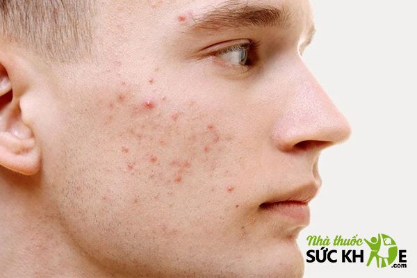 Xác định chính xác loại da để chọn sữa rửa mặt cho nam