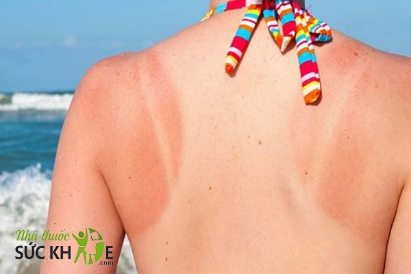 Kem chống nắng body bảo vệ da và hạn chế cháy nắng