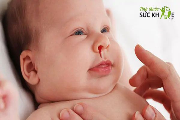 Trẻ thiếu hụt Vitamin K dễ bị chảy máu cam và xuất hiện vết bầm tím
