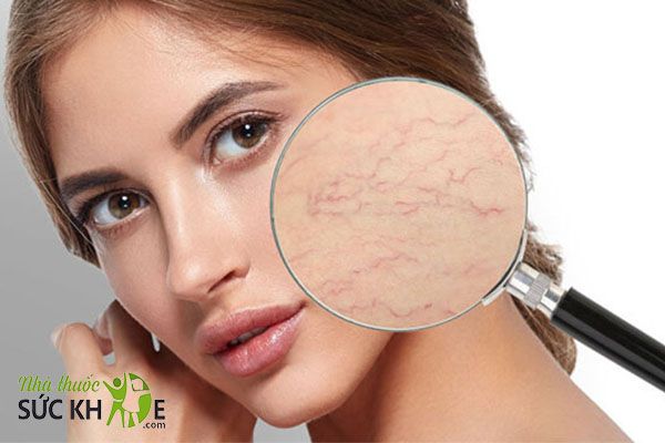 Tác dụng của kem chống nắng giúp hạn chế suy giãn tĩnh mạch