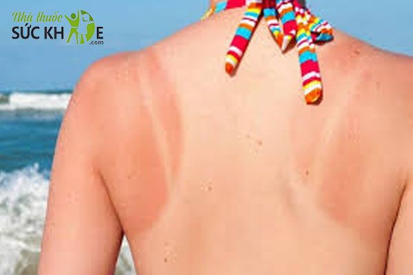Tác dụng kem chống nắng cải thiện cháy nắng