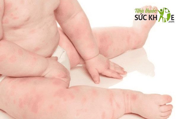 Dùng qúa liều Vitamin D3 cho trẻ sơ sinh Aquadetrim trong thời gian dài có thể gây tác dụng phụ