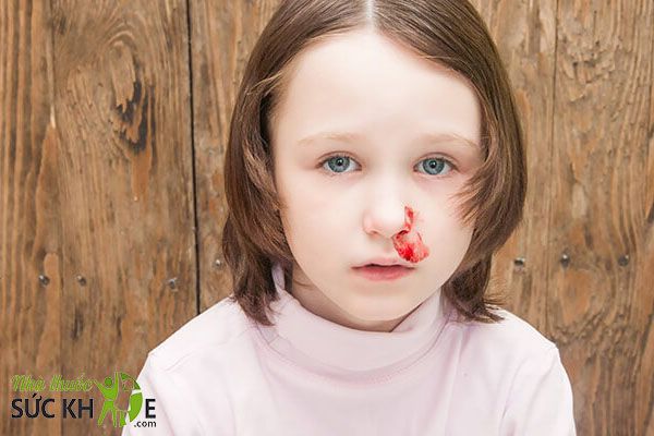 Trẻ hay bị chảy máu mũi, bầm tím trên cơ thể là dấu hiệu cho thấy bé thiếu Vitamin K