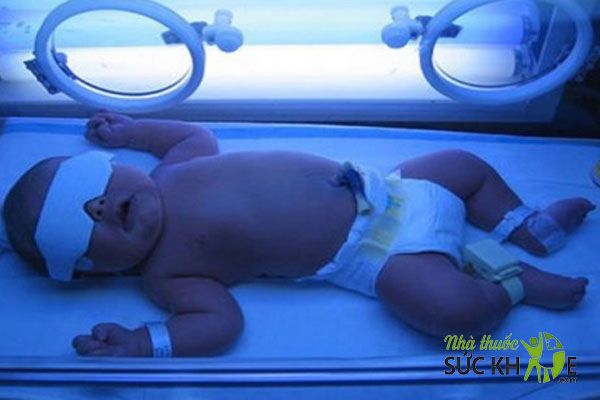 Trẻ vàng da cần chiếu đèn
