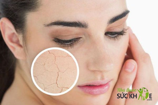 Cải thiện làn da khô, nứt nẻ