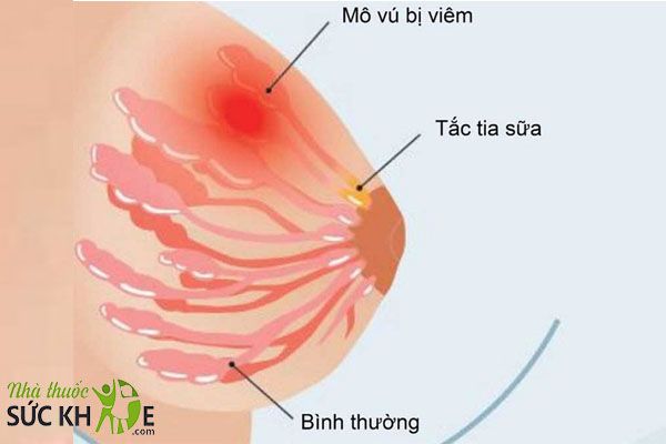 Tắc tia sữa là tình trạng phổ biến ở nhiều mẹ sau sinh