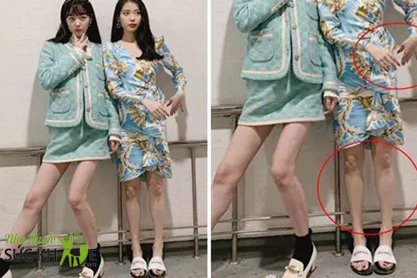 Giảm cân quá mức gây ảnh hưởng đến sức khỏe