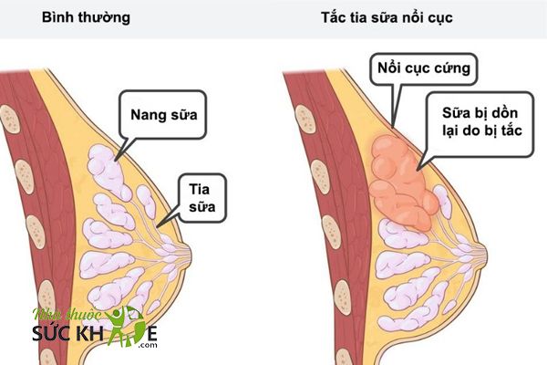 Phòng ngừa áp xe tuyến vú
