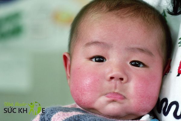 Có nhiều nguyên nhân khiến da bé khô, nứt nẻ
