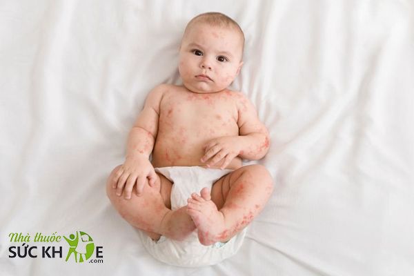 Trẻ bị dị ứng đạm sữa bò bị nổi mẩn đỏ, đi ngoài, nôn trớ