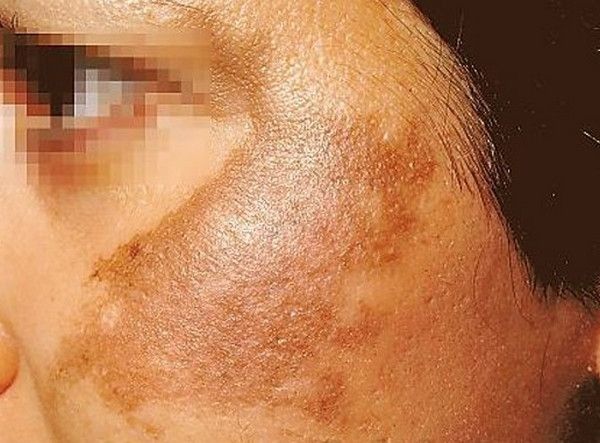 Rám má là gì? Nguyên nhân và điều trị rám má hiệu quả?