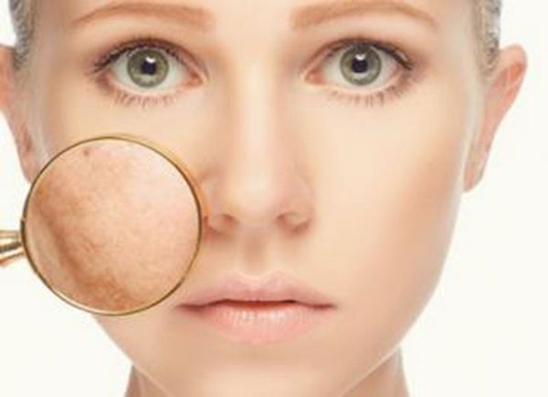 Rám má là gì? Nguyên nhân và điều trị rám má hiệu quả?