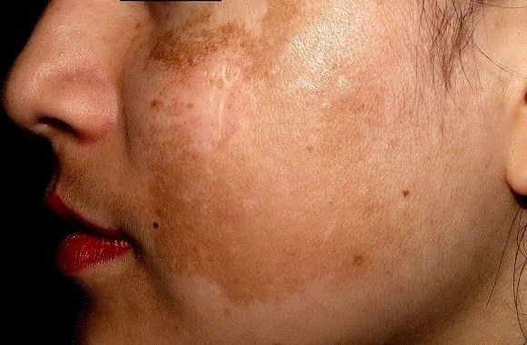 Rám má là gì? Nguyên nhân và điều trị rám má hiệu quả?