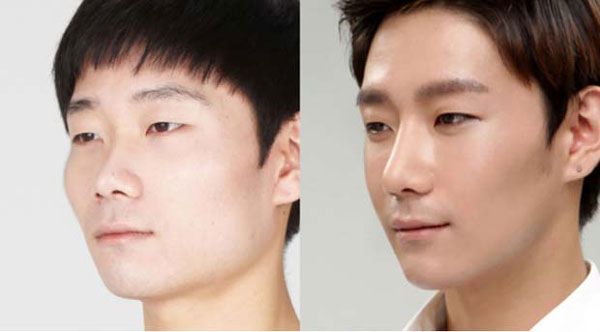 Nâng mũi cấu trúc là gì? Ưu, nhược điểm và những thông tin cần biết
