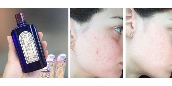 Review Lotion trị mụn Meishoku và cách sử dụng HIỆU QUẢ NHẤT