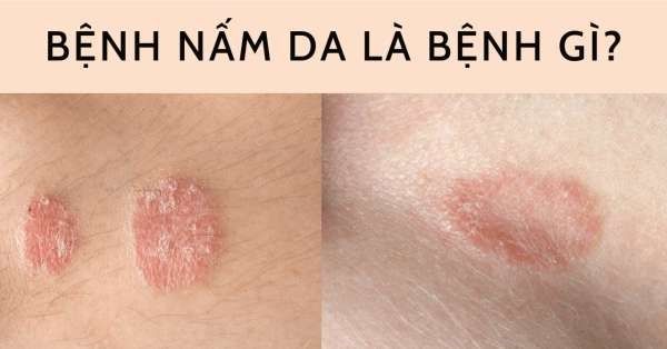 5 loại bệnh nấm da thường gặp: triệu chứng và cách điều trị