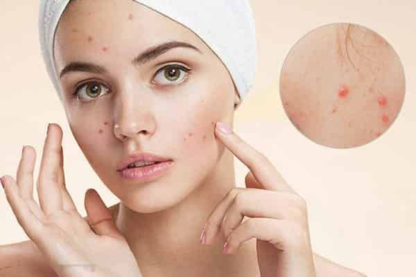 Top 6 kem trị mụn hiệu quả nhất