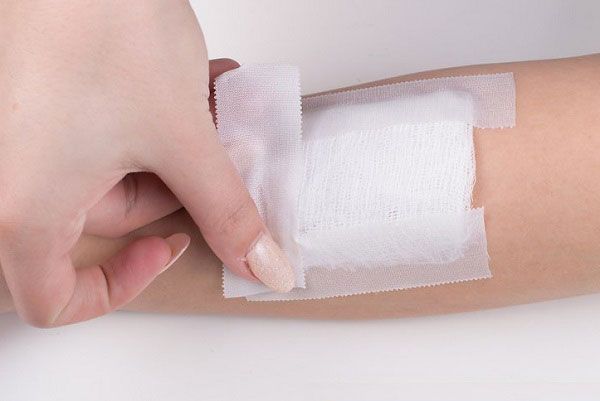 Hướng dẫn chăm s&oacute;c vết thương kh&acirc;u chỉ tự ti&ecirc;u