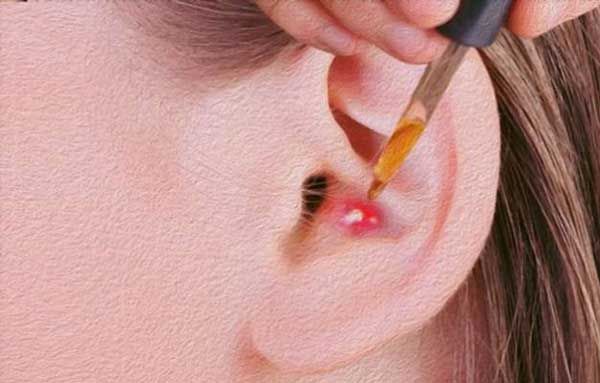  Mụn trong tai b&ocirc;i thuốc g&igrave;?